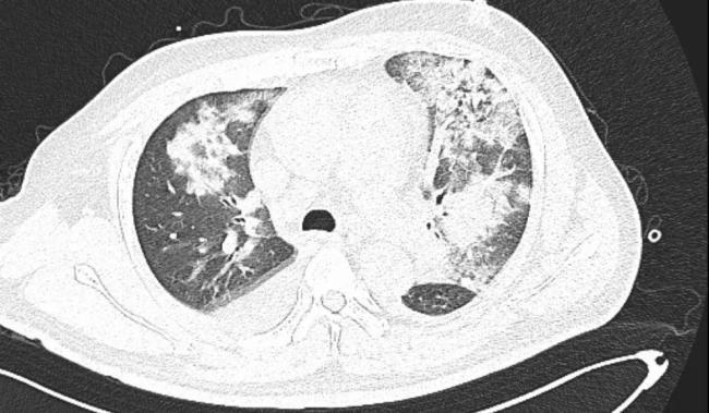 41岁男子吹久未清洗空调肺变白进ICU 军团菌肺炎险夺命