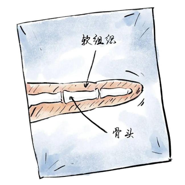用小拇指当手机支架 手指会废吗 全网辟谣+权威研究