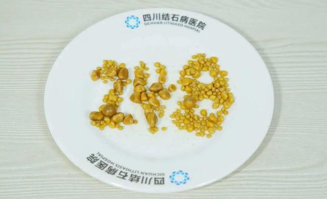 小伙天天吃外卖长248颗胆结石 高脂饮食惹祸