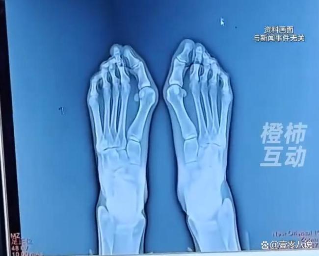 德训鞋和高跟鞋一样会导致踇外翻 首批受害者现身