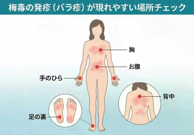 日本为何会出现梅毒疫情 药物短缺与社会因素交织