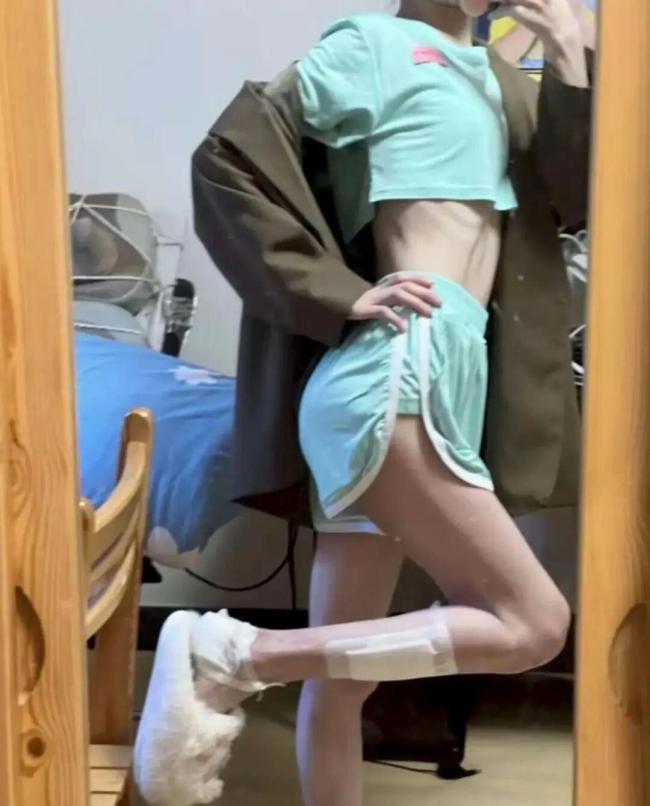 吃播女网红去世前多次展示手背上的针眼 暴食症下的悲剧