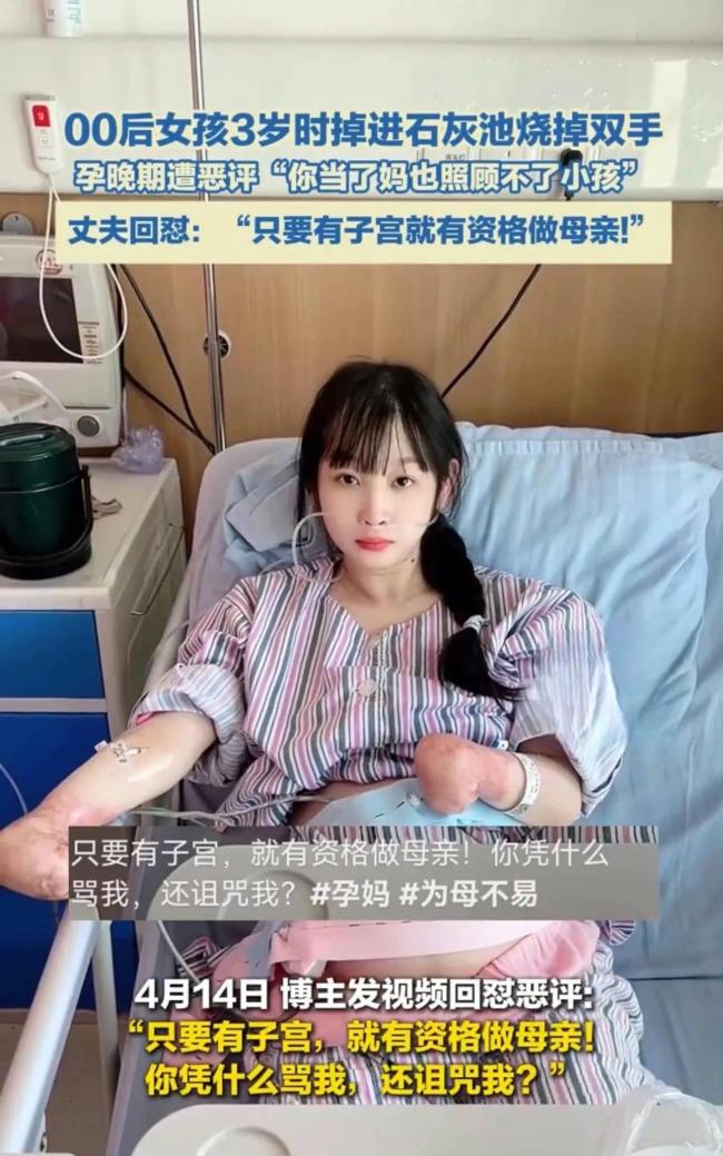 女子3岁烧掉双手现孕珠9个月遭质疑 丈夫回怼恶评
