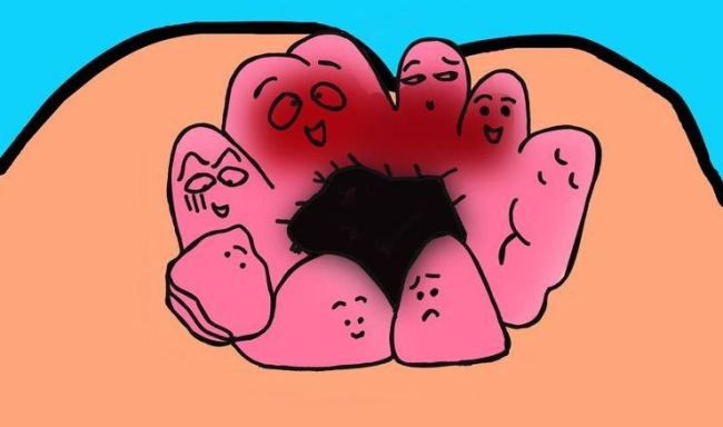 痔疮肉球脱出怎么缩回一个花季少女的肉球缩回秘诀