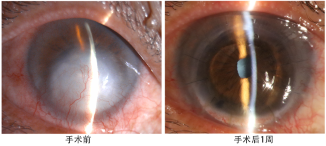 重启清晰视界！山东省千佛山医院眼科成功开展穿透性及深板层角膜移植手术