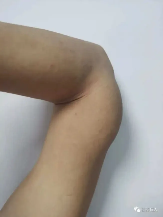 这病全球儿童患者仅50例——“木村病”患儿在山大齐鲁二院被精准确诊并成功治愈