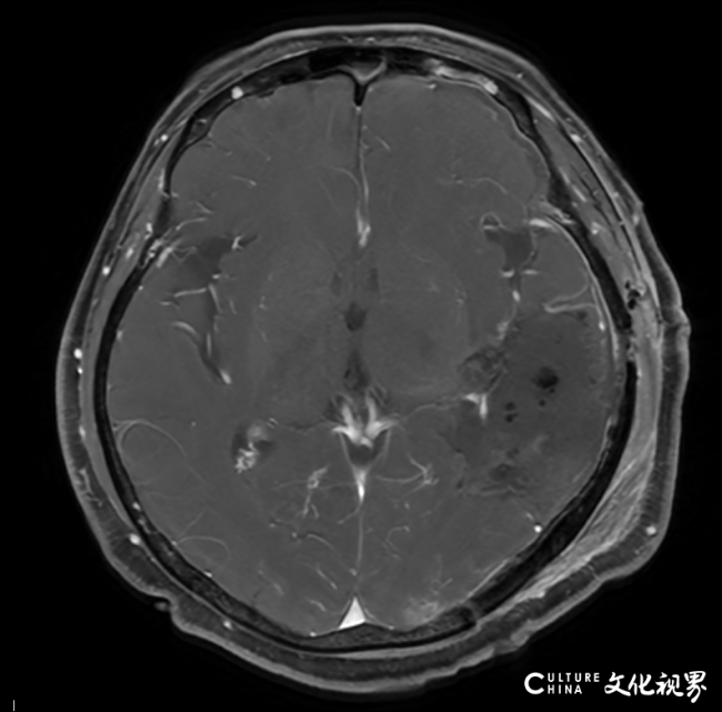 从子宫到肺，再到大脑——抗癌十三载患者在银丰（济南）医院神经肿瘤科成功接受开颅肿瘤切除术，再现希望之光