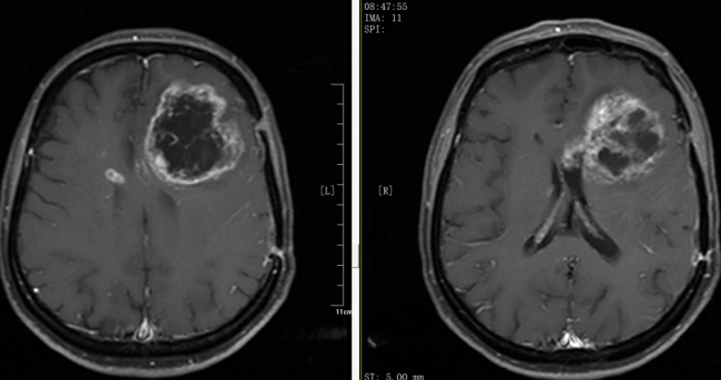 银丰（济南）医院神经肿瘤科成功为胶质母细胞瘤患者实施左额叶病损切除术