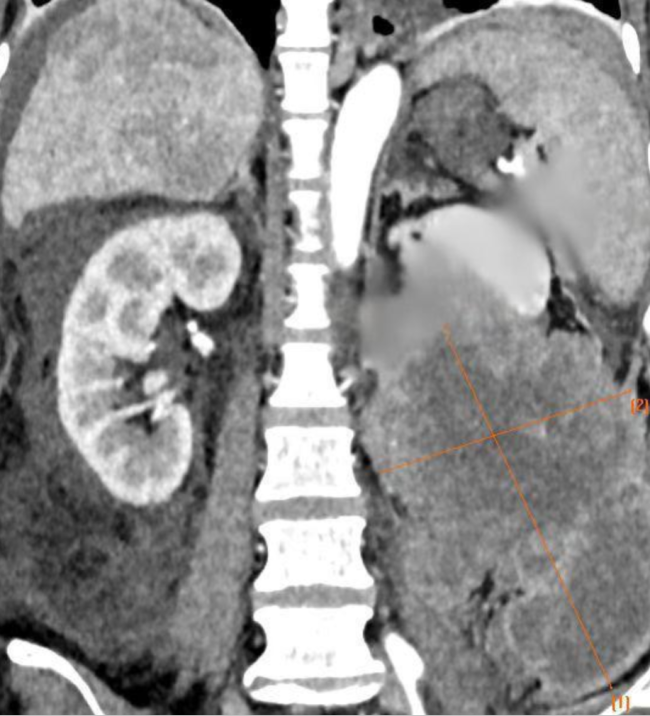 西安国际医学中心医院多学科协作 攻克18cm肾巨瘤难题