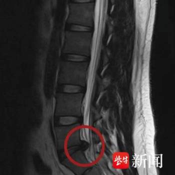 体重200斤大学生久坐致腰椎做手术 久坐打游戏惹的祸