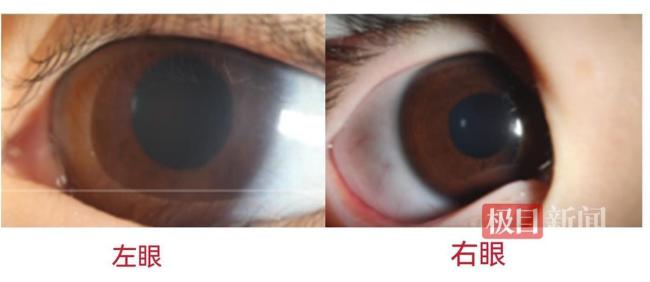 女童黑眼珠不对称确诊先天性青光眼 警惕视力“杀手”