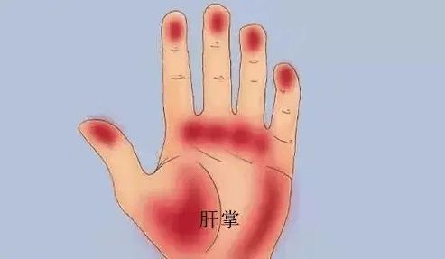 醫(yī)生：身體有癌 雙手先知,，尤其是肝癌