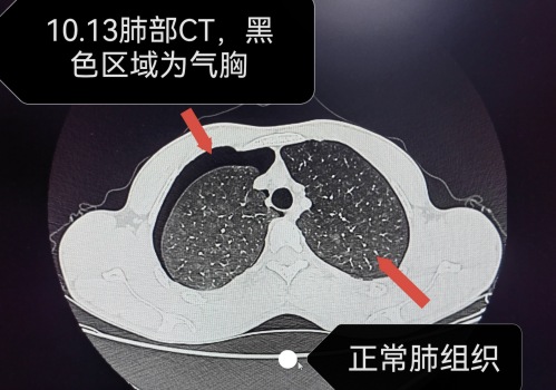 小伙深夜胸痛到無法呼吸確診帥哥病 瘦高個需警惕氣胸風險