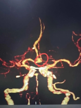 6兩白酒下肚引爆男子腦內(nèi)炸彈 酒精成“導(dǎo)火索”