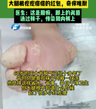 60歲大爺內(nèi)衣襪混洗感染股癬 醫(yī)生提醒