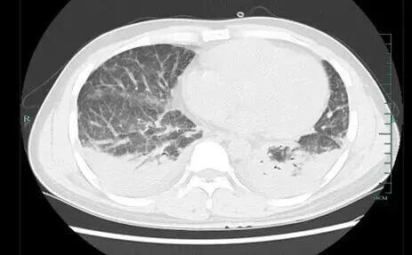 男子吃野生竹鼠后高烧 肺部感染真菌险致命