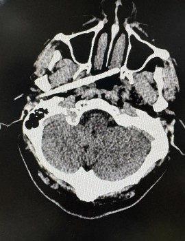 男子被筷子从耳部直插颅底惊险获救 距颈动脉仅5毫米