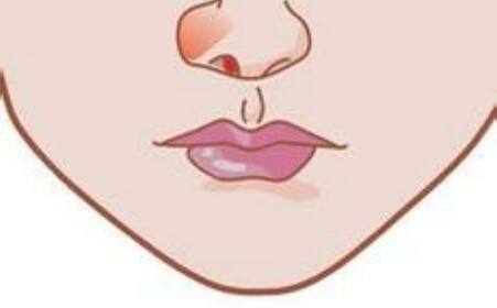 鼻息肉会引发哪些并发症呢？