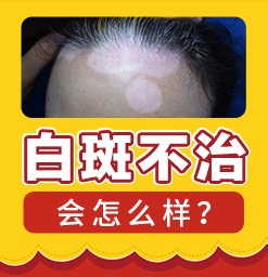 郑州治疗女性患有白癜风哪家好 郑州西京白癜风医院怎么样