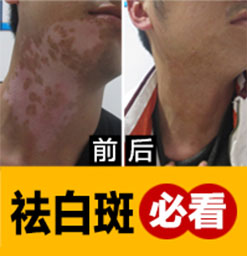 郑州西京白癜风专科医院治疗女性白斑口碑好吗