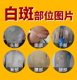 郑州西京白癜风医院网上怎么预约挂号