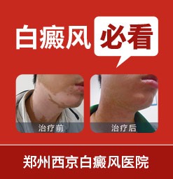 郑州西京白癜风医院看白斑*好吗 白癜风生活中要注意什么