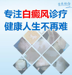 烟台白癜风怎么治疗才能有 烟台半岛是正规医院吗