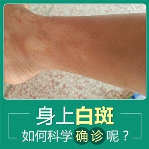 烟台看白癜风哪家医院治疗方法好/科学又靠谱