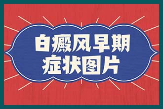 昆明有没有专治白癜风的医院 得了白癜风有危害吗