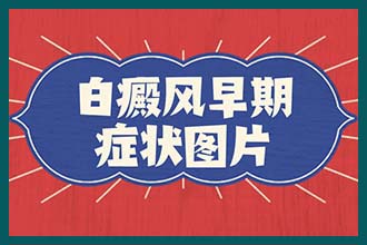 广东深圳哪个医院治白癜风好?
