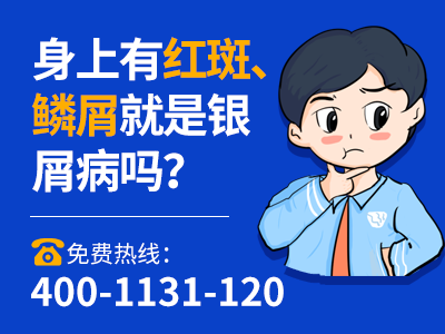 是癣吗怎么治_癣怎么*得快