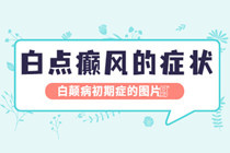 东莞白点癫风体表特征