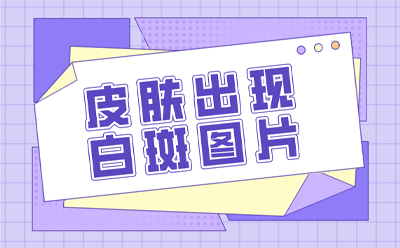 郑州白癜风医院排名前十名 治疗白癜风的时候需要注意什么呢