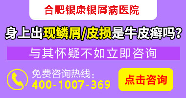 合肥市治疗牛皮癣专家_合肥牛皮癣哪家医院能治疗好