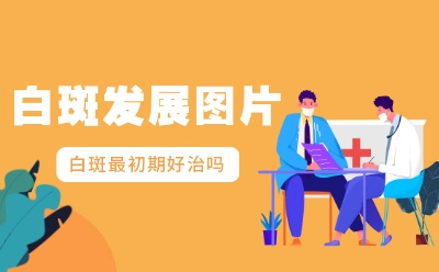 威海白癜风医院有哪几家,白癜风患者饮食健康