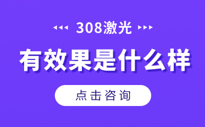 福州治疗白癜风的医院?白癜风能不能激光治疗