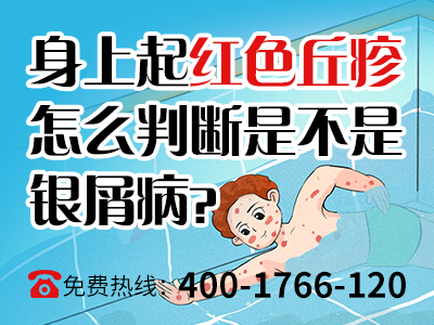 郑州市银屑病专病门诊药费贵吗_郑州市银屑病专病门诊收费标准