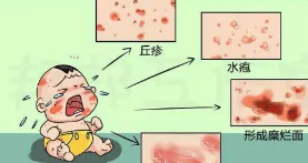 上海治疗湿疹医院哪家好-湿疹怎么治疗能除根