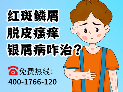 郑州市银屑病专病门诊治疗牛皮癣收费贵吗_郑州市银屑病专病门诊靠谱吗