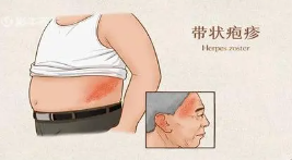 上海带状疱疹神经痛医院排名-带状疱疹后遗神经痛新治疗方法