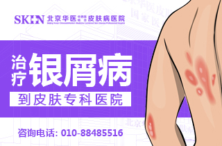 北京哪家皮肤科看银屑病好些-银屑病引起关节炎吗