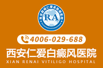 白斑问题：西安市白癜风医院具体名单-局限型白斑病有什么症状特点